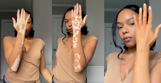 How Amara Turned Her Vitiligo Into a Work of Art—And How You Can Too